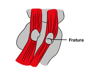 Imagem ilustrativa mostrando o local da fratura do osso sesamoide.