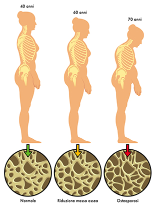 Diminuição da estatura provocada pela osteoporose.