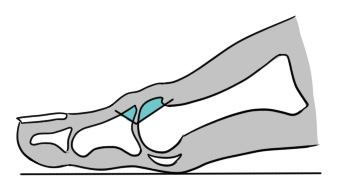 Ilustração da osteotomia.