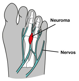 Neuroma de Morton Tratamento