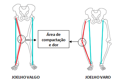 25. A linha vermelha mostra tornozelos e joelhos desalinhados e linha azul mostra a correção do alinhamento pela colocação da palmilha nos pés.
