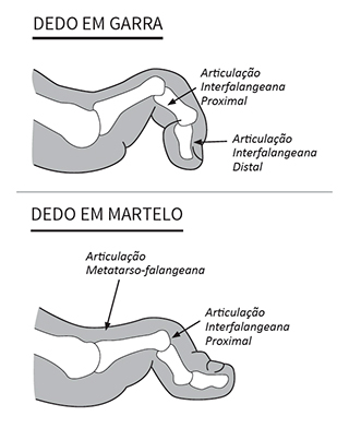 Imagem ilustrativa com a comparação entre o dedo em martelo com o dedo em garra.