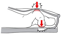 Imagem ilustrativa mostrando como o calçado apertado interfere na formação do dedo.